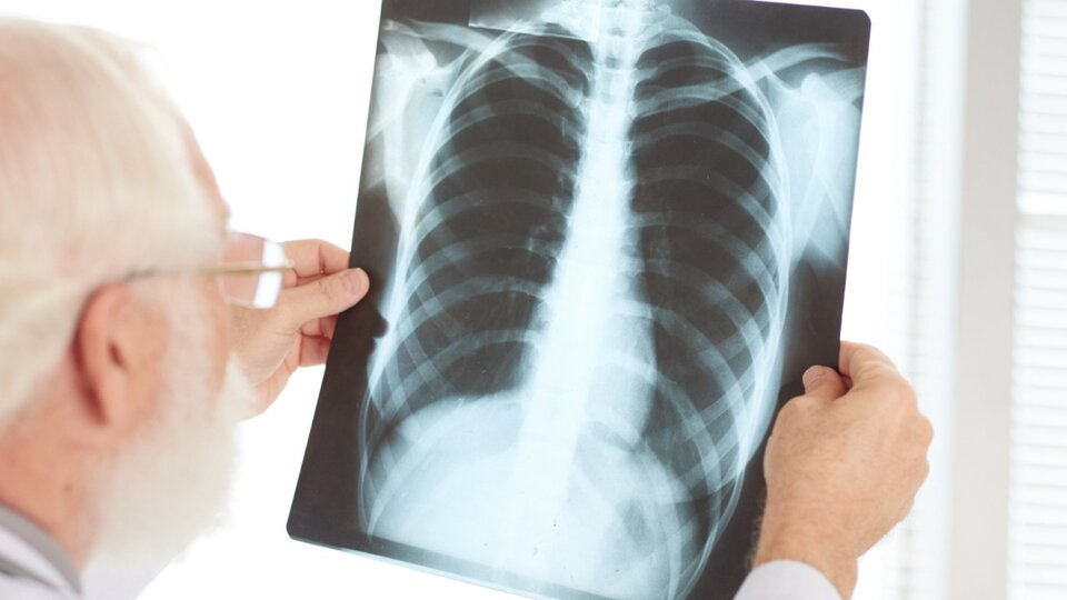 Infectólogo de SADI advierte sobre el impacto de la tuberculosis en la población joven