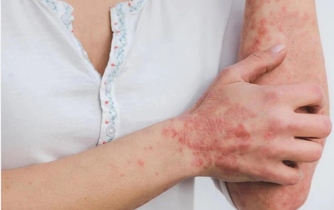 Varios países registran casos de viruela del mono y temen que el virus se esté expandiendo