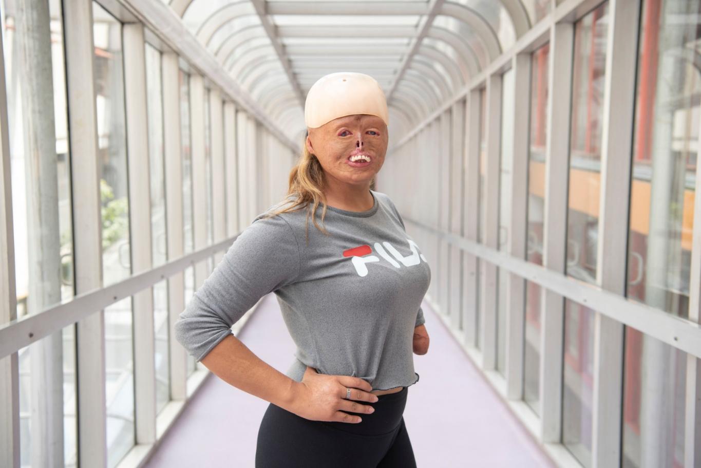 Brisa: a los 7 meses se quemó el 90% de   su cuerpo y hoy es deportista y modelo